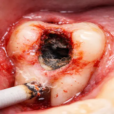 خشکی حفره دندان (Dry Socket) بعد از کشیدن دندان و سیگار