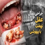 هزینه جراحی دندان عقل نهفته با بیهوشی