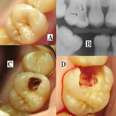 مقایسه عکس واقعی با رادیوگرافی