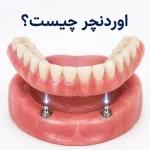اوردنچر چیست؟
