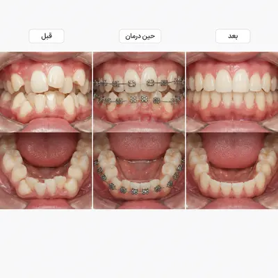 قبل و بعد ارتودنسی ثابت شدید