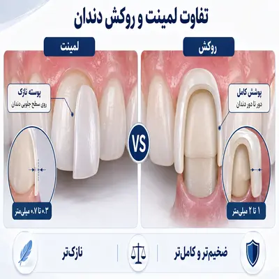 عکس مقایسه علمی لمینت و روکش دندان