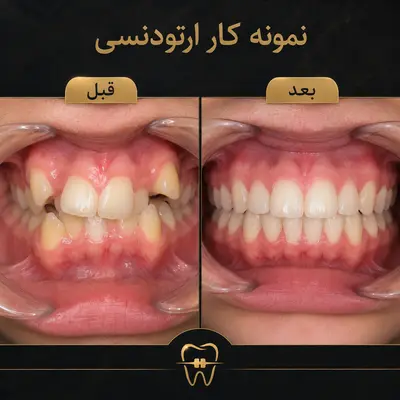 قبل و بعد ارتودنسی دندان‌های نامرتب