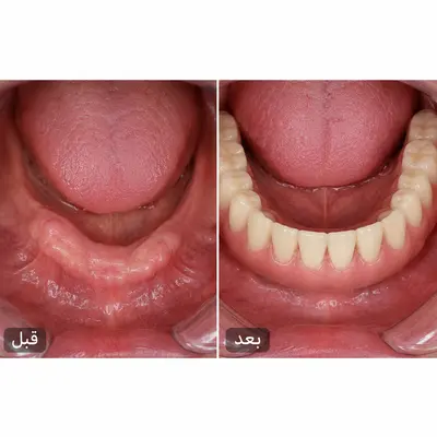 مشکلات اوردنچر