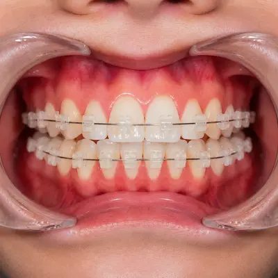 ارتودنسی سرامیکی با براکت شفاف