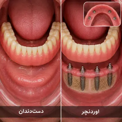 هزینه دست‌دندان کامل اوردنچر