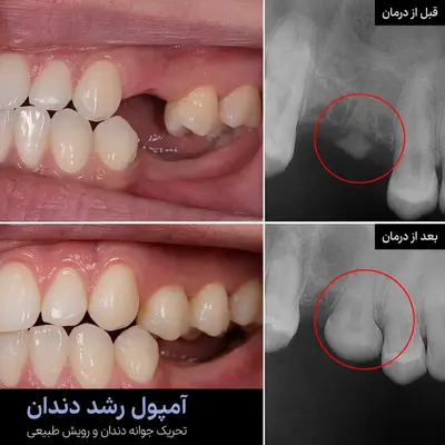 آمپول رویش مجدد دندان در ژاپن