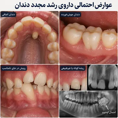 عوارض رویش مجدد دندان برای سومین بار