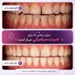 آیا برای لمینت، دندان تراشیده می‌شود؟