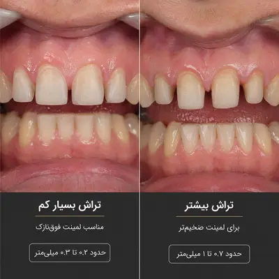 لمینت بدون تراش