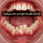 آیا دندان عقل باعث کج شدن دندان می‌شود؟