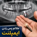 علائم پس‌زدن ایمپلنت