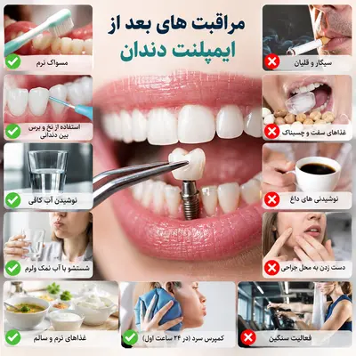 مراقبت بعد از ایمپلنت دیجیتال