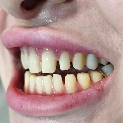 عکس دندان تراش خورده برای لمینت