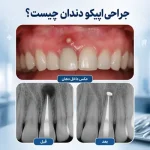 جراحی اپیکو دندان چیست؟ هزینه، عوارض و میزان موفقیت