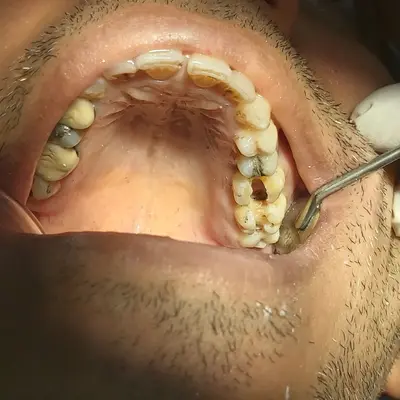 تصویر دندان با حفره‌ی خالی بعد از افتادن ماده