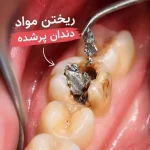 افتادن مواد دندان پرشده و ترمیم مجدد آن