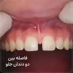 فاصله بین دو دندان جلو؛ علت، روش بستن و هزینه