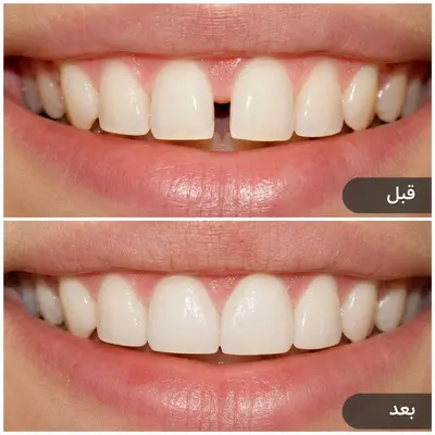 هزینه بستن فاصله بین دندان‌های جلو