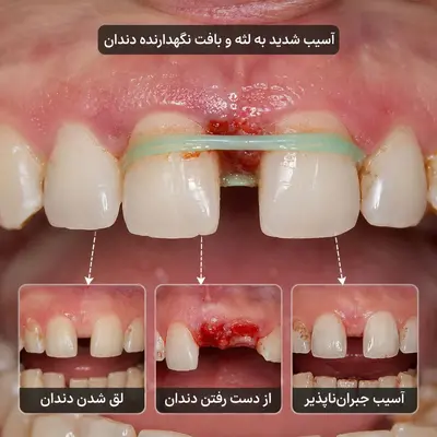 از بین رفتن فاصله دندان در خانه