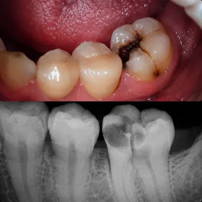 نبض دندان نشانه‌ی چیست