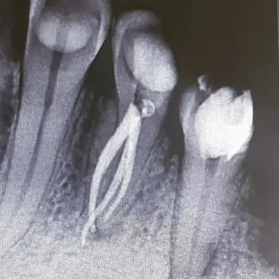 عصب کشی توسط متخصص درمان ریشه