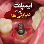 ایمپلنت برای دیابتی‌ها؛ شرایط ایمپلنت دندان برای افراد دیابتی
