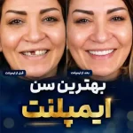 بهترین سن ایمپلنت دندان؛ از سن مناسب تا ایمپلنت در سن بالا