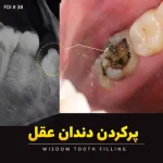 پرکردن دندان عقل