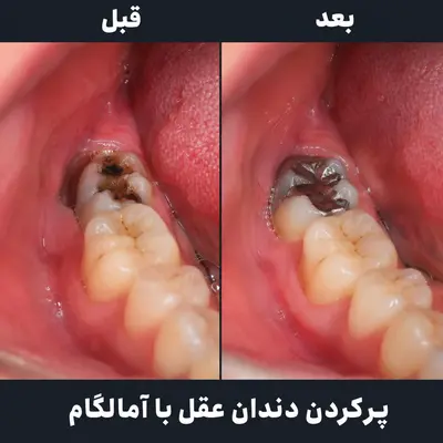 پرکردن دندان عقل با آمالگام