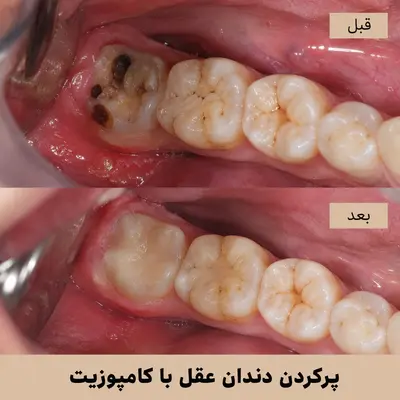 پرکردن دندان عقل با کامپوزیت