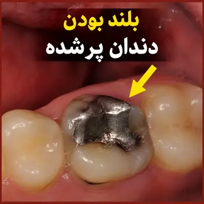 بلند بودن دندان آمالگام