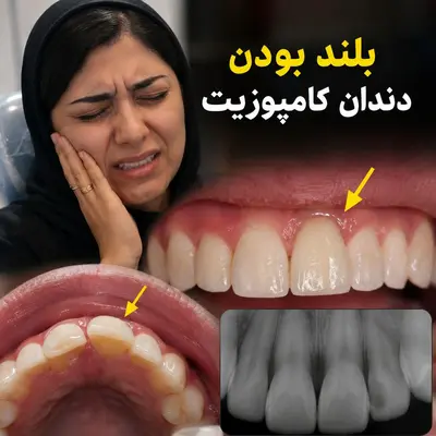 بلند بودن دندان کامپوزیت