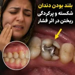 بلند بودن دندان پرشده