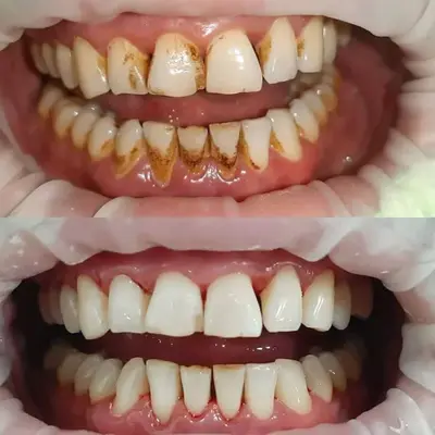 بلیچینگ در خانه بهتر است یا در مطب