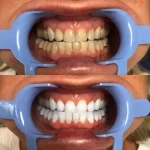 فرق بلیچینگ هوم و آفیس؛ کدام روش بهتر است؟