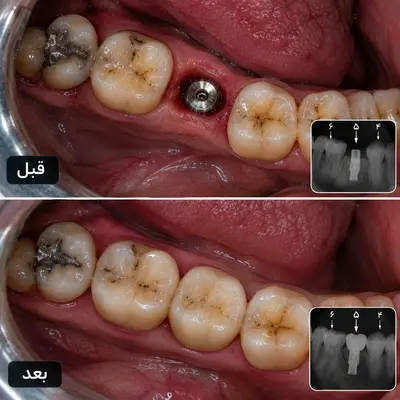 فیکسچر ایمپلنت کرهای از جنس تیتانیوم پزشکی