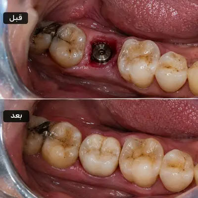 درپوش هیلینگ روی ایمپلنت برای فرمدهی لثه