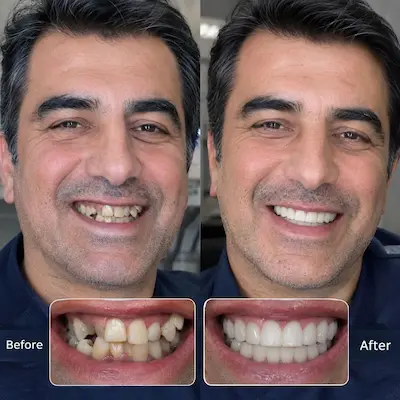 لمینت سرامیکی روی دندانهای جلو
