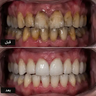 جرم‌گیری با ایرفلو برای پاک کردن لکهٔ چای، قهوه و سیگار