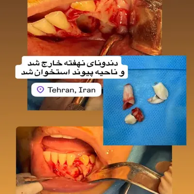 بیماری هایپردونتیا