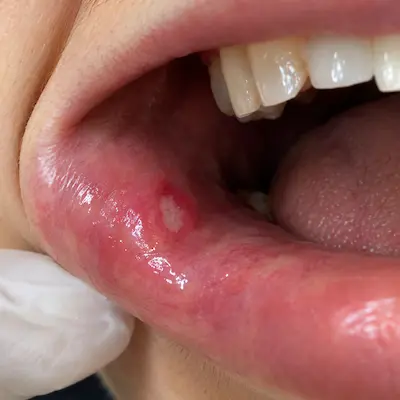 عکس آفت دهان بزرگسالان؛ زخم گرد با مرکز سفید و حاشیه قرمز داخل لب پایین